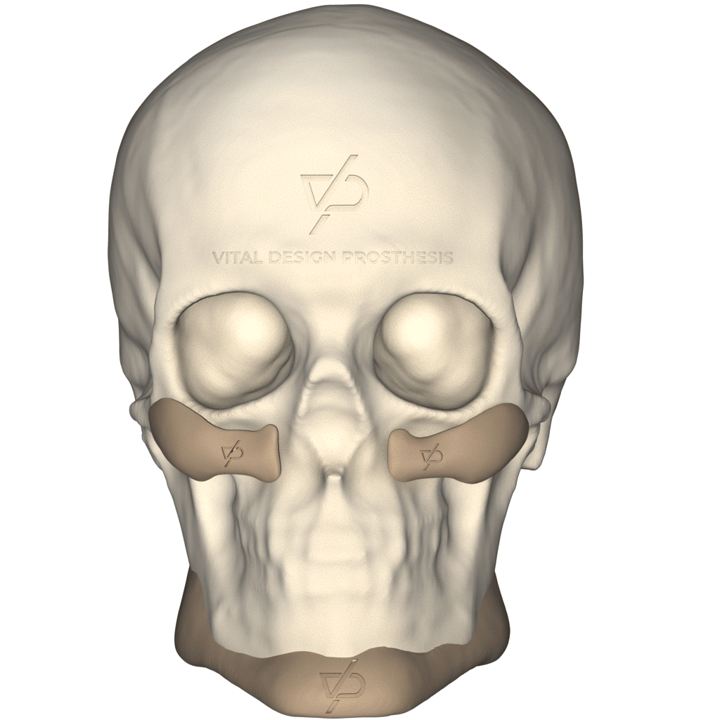 Facial_Augmentation_Implant