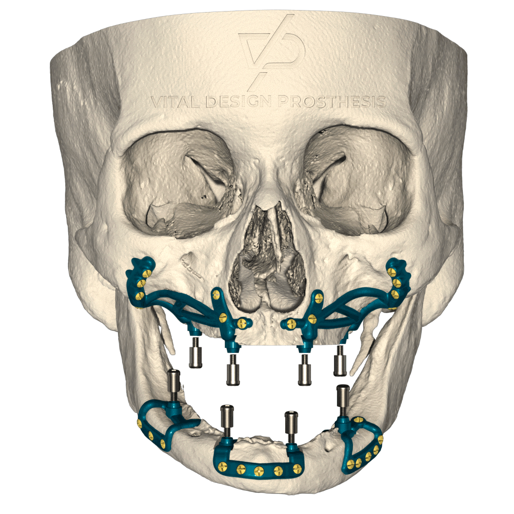 Frontal view of patient with severe maxillary atrophy with personalized bilateral subperiosteal implant with special adaptation for locator.