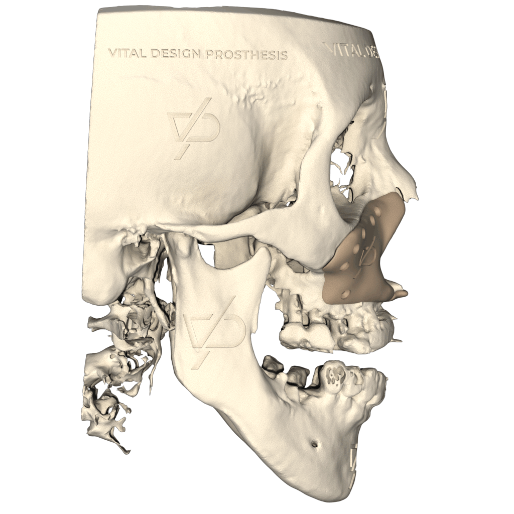 Vista lateral derecha de paciente con secuelas de labio y paladar hendido e hipoplasia malar con aumento facial a la medida fabricado en PEEK.