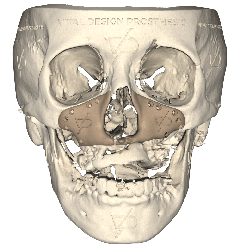 Vista frontal de paciente con secuelas de labio y paladar hendido e hipoplasia malar con un implante de aumento facial personalizado, otorgándole una mejoría facial.