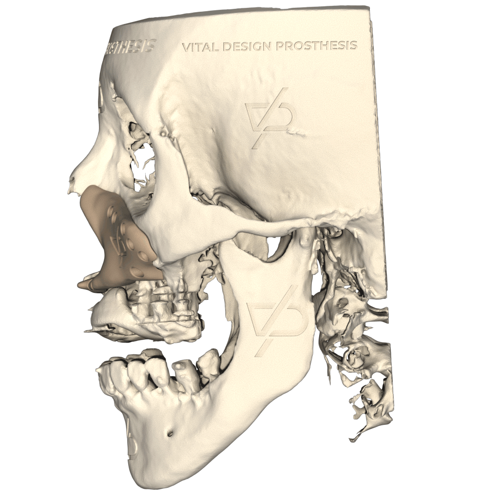 Vista lateral izquierda de paciente con secuelas de labio y paladar hendido e hipoplasia malar con un implante facial a la medida en PEEK.