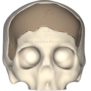 Vista frontal de paciente que sufrió TCE Severo, le tuvieron que realizar craniectomía descompresiva frontal bilateral y posteriormente le realizaron craneoplastia personalizada con implante PEEK en 3D.