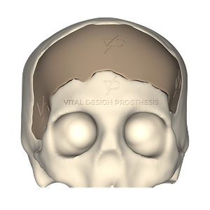 Vista frontal de paciente que sufrió TCE Severo, le tuvieron que realizar craniectomía descompresiva frontal bilateral y posteriormente le realizaron craneoplastia personalizada con implante PEEK en 3D.