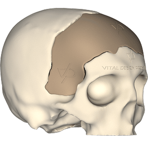 Vista isométrica derecha de paciente que sufrió TCE Severo, le tuvieron que realizar craniectomía descompresiva frontal bilateral y posteriormente le realizaron craneoplastia personalizada con implante PEEK en 3D.