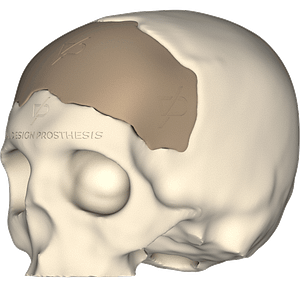 Vista isométrica izquierda de paciente que sufrió TCE Severo, le tuvieron que realizar craniectomía descompresiva frontal bilateral y posteriormente le realizaron craneoplastia personalizada con implante PEEK en 3D.