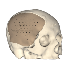 Vista isométrica de paciente con implante personalizado de cráneo de lado derecho de gran tamaño.