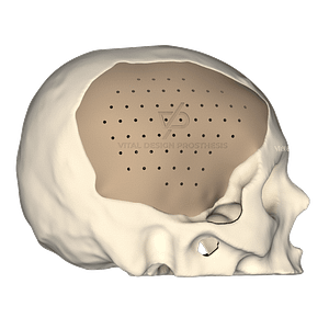 Vista lateral derecha de paciente con implante personalizado de cráneo de lado derecho de gran tamaño.