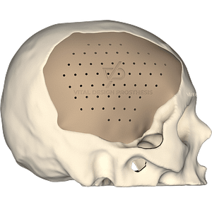 Vista lateral derecha de paciente con implante personalizado de cráneo de lado derecho de gran tamaño.
