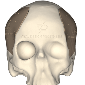 Vista frontal de paciente que tuvo craniectomía descompresiva bilateral y que le realizaron cranioplastia con implante de PEEK personalizado en 3D.