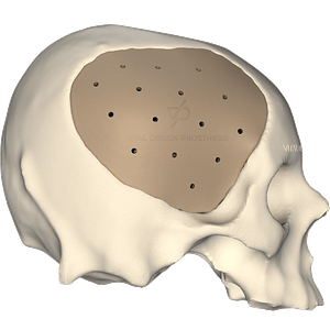 Vista lateral derecha de paciente que tuvo craniectomía descompresiva bilateral y que le realizaron cranioplastia con implante de PEEK personalizado en 3D.