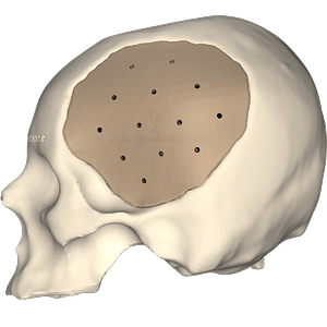 Vista lateral izquierda de paciente que tuvo craniectomía descompresiva bilateral y que le realizaron cranioplastia con implante de PEEK personalizado en 3D.