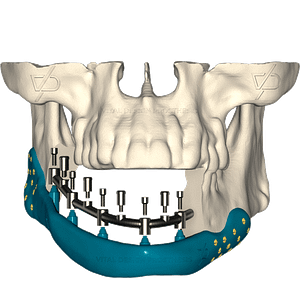 Mandibular_Reconstruction