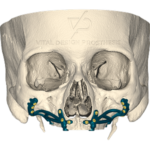 Frontal view of patient with severe maxillary atrophy with personalized bilateral subperiosteal implant without prosthetic attachments.