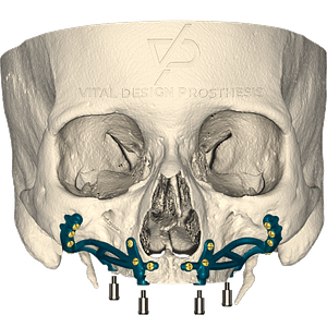 Frontal view of patient with severe maxillary atrophy with personalized bilateral subperiosteal implant with special adaptation for locator.