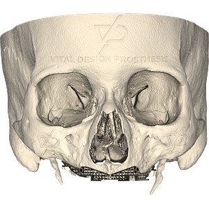 Frontal view of patient with severe maxillary atrophy with surgical cutting guidance and osteotomy performed prior to placement of personalized subperiosteal implant.