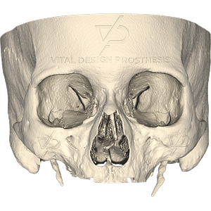 Frontal view of patient with severe maxillary atrophy and osteotomy performed with personalized cutting guide prior to placement of personalized subperiosteal implant.