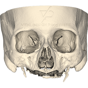 Frontal view of a patient with severe maxillary atrophy with cutting surgical guidance prior to placement of a personalized subperiosteal implant.