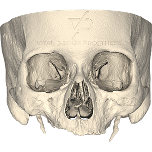 Frontal view of patient with severe maxillary atrophy.