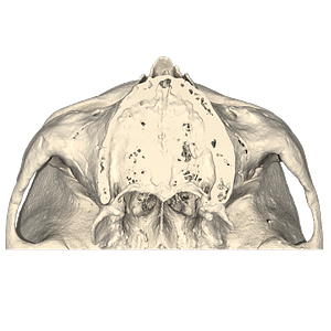 View of the upper jaw in axial plane of patient with severe maxillary atrophy after osteotomy made with a custom surgical guide.