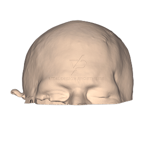 Vista frontal de paciente posterior a craneoplastia personalizada con implante a la medida de PEEK.