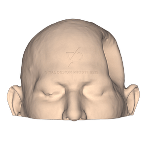 Vista frontal de paciente con el defecto óseo y la piel sumida debido a una craniectomía descompresiva por un traumatismo cráneo encefálico severo.