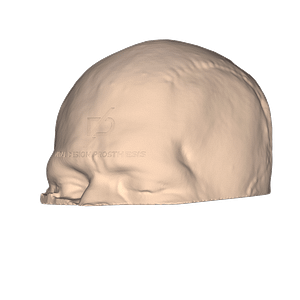 Vista isométrica de paciente posterior a craneoplastia personalizada con implante a la medida de PEEK.