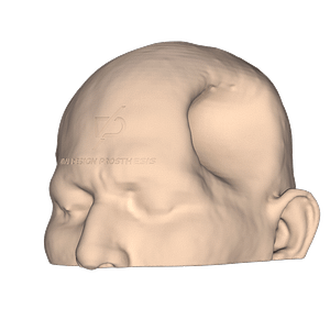 Vista isométrica izquierda de paciente con el defecto óseo y la piel sumida debido a una craniectomía descompresiva por un traumatismo cráneo encefálico severo.