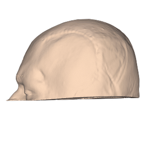 Vista lateral de paciente posterior a craneoplastia personalizada con implante a la medida de PEEK.