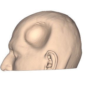 Vista lateral izquierda de paciente con el defecto óseo y la piel sumida debido a una craniectomía descompresiva por un traumatismo cráneo encefálico severo.