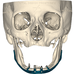 Frontal view of patient with severe bilateral atrophic jaw with subperiosteal implant made of titanium grade 23 simulating a all on 4 type implant with differents types of attachments in each base.