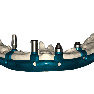 Personalized mandibular subperiosteal implant type all on 4 made to measure in titanium, with rehabilitation bases for different types of attachments.