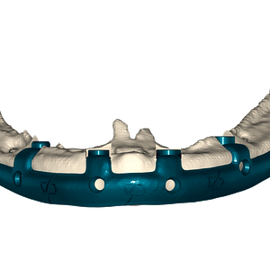 Personalized mandibular subperiosteal implant type all on 4 made in titanium.