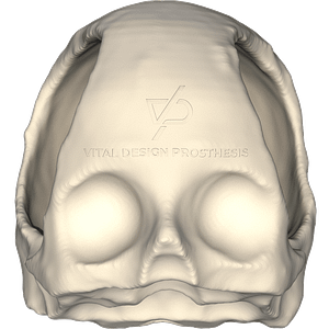 Vista frontal de paciente que tuvo craniectomía descompresiva bilateral por traumatismo cráneo encefálico severo.