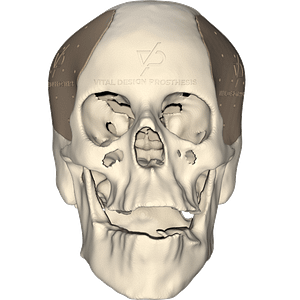 Vista frontal de paciente que tuvo craniectomía descompresiva bilateral y que le realizaron cranioplastia con implante de PEEK personalizado en 3D.