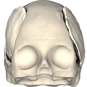 Vista frontal de paciente que tuvo craniectomía descompresiva bilateral y que le realizaron cranioplastia con implante de PMMA Polimetilmetacrilato a mano, teniendo resultados deficientes.