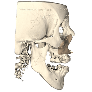 Vista lateral derecha de paciente con secuelas de labio y paladar hendido e hipoplasia malar con aumento facial a la medida fabricado en PEEK.