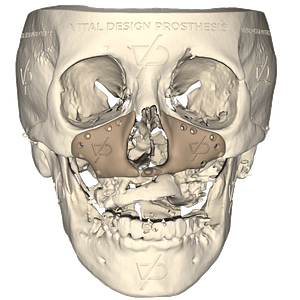 Vista frontal de paciente con secuelas de labio y paladar hendido e hipoplasia malar con un implante de aumento facial personalizado, otorgándole una mejoría facial.