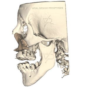 Vista lateral izquierda de paciente con secuelas de labio y paladar hendido e hipoplasia malar con un implante facial a la medida en PEEK.