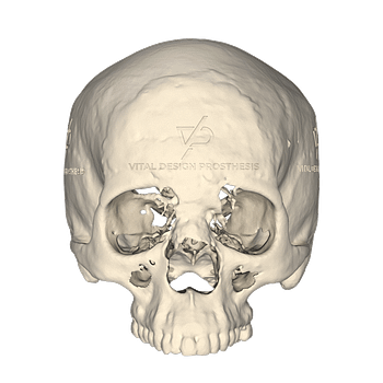 Vista frontal de paciente con meningioma transicional sin tratar.