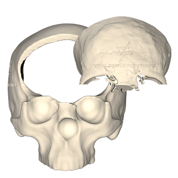 Vista frontal de paciente con meningioma transicional y el segmento con tumor retirado.