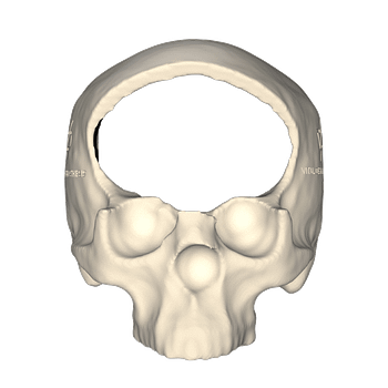 Vista frontal de paciente con meningioma transicional retirado mediante guía de corte de titanio.