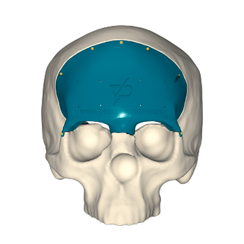 Vista frontal de paciente con meningioma transicional retirado y con cirugía reconstructiva con implante personalizado de titanio.