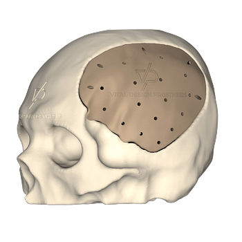 Vista isométrica izquierda de paciente que sufrió un traumatismo cráneo encefálico severo. Para reconstrucción de cráneo se le realizó una craneoplastía personalizada en PEEK.