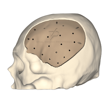 Vista lateral izquierda de paciente que sufrió un traumatismo cráneo encefálico severo. Se sometió a una reconstrucción de cráneo y se le realizó una craneoplastía personalizada en PEEK.