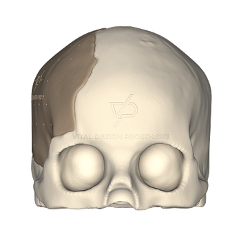 Vista frontal de paciente que sufrió un TCE Severo, le realizaron craniectomía descompresiva de urgencia y luego una craneoplastía con implante a la medida en PEEK 3D.