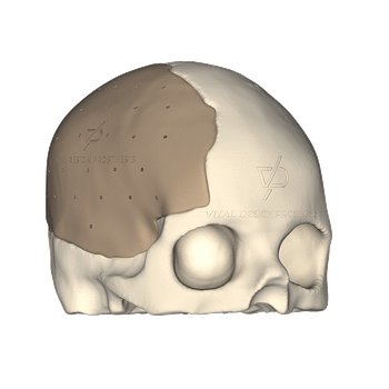 Vista isométrica derecha de paciente que sufrió un TCE severo y que le tuvieron que realizar una craniectomía descompresiva de urgencia. Para la reconstrucción se le realizó craneoplastia con PEEK a la medida.