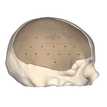 Vista lateral derecha de paciente que lo sometieron a una craniectomía descompresiva por TCE severo. Para la reconstrucción se le realizó craneoplastia con implante PEEK a la medida.