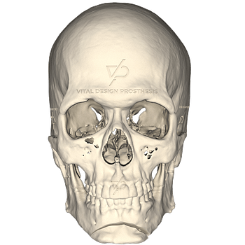 Vista frontal de paciente con aumento facial en ángulo mandibilar bilateral, fabricados en PEEK.