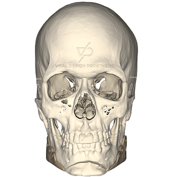 Vista frontal de paciente con aumento facial en ángulo mandibilar bilateral, fabricados en PEEK.