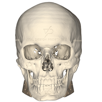 Vista frontal de paciente con aumento facial en ángulo mandibilar bilateral, fabricados mediante manufactura aditiva en PEEK.